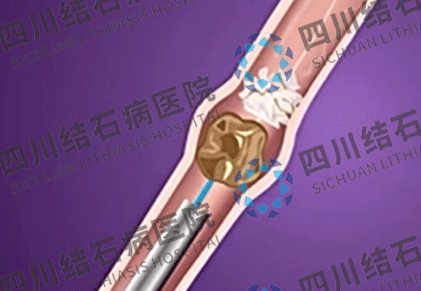软镜取石,不开刀取净输尿管结石(图1) 软镜取石,不开刀取净输尿管结石(图1)