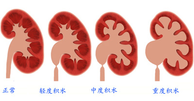 不再迷茫了，输尿管结石的几种治法详解(图1)