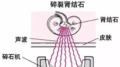 体外碎石的三个注意事项，你都清楚了吗(图2)