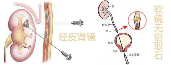 【成都商报】信手摘下双镜之花——疑难肾结石解决专家、四川结石(图3)
