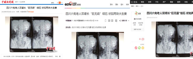 【成都商报】信手摘下双镜之花——疑难肾结石解决专家、四川结石(图10)