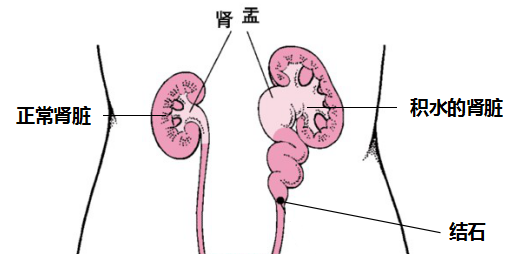 怎么轻松解决输尿管结石伴肾积水？(图1)