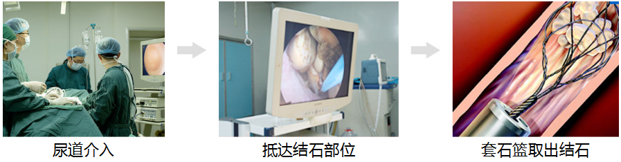 治疗输尿管结石的不开刀镜下取石术(图4)