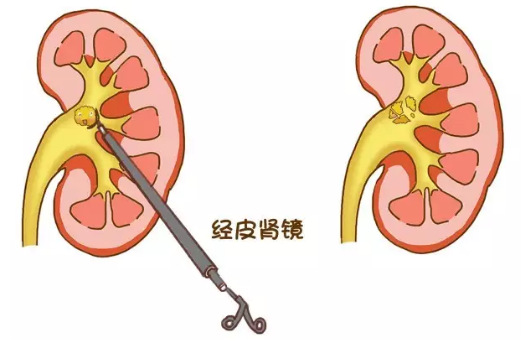 全面解析尿结石的各类手术(图6)