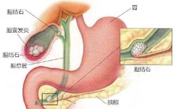 打结石到底好不好？(图5)