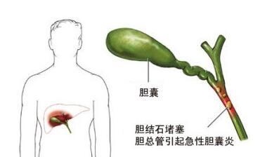 多大的胆结石需手术治疗？听专家详细分析(图2)