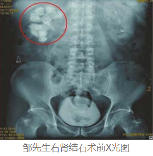 他体外碎石居然花了几十万，真相让所有人惊呆(图2)