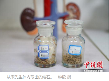 一天一杯浓茶，他肾里长满了这个东西(图1)