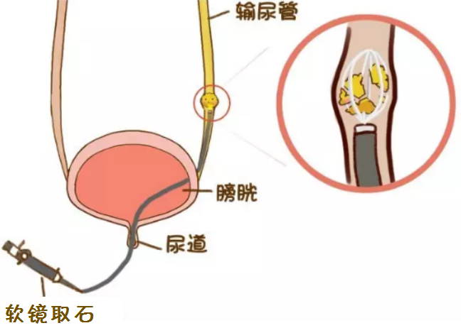 你的输尿管结石，应该这样排！(图4)
