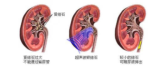 体外碎石，你真的能碎吗？1分钟带你全面了解体外碎石(图5)