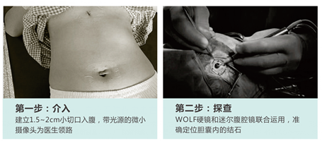 论胆结石的治疗方法是什么?(图6) 论胆结石的治疗方法是什么?(图6)