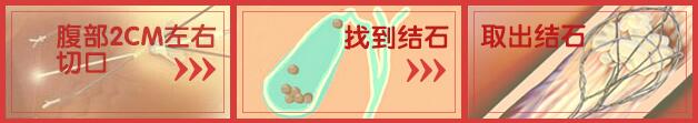 【关于切胆】专家：胆结石不是一定要选择这个治法(图3)