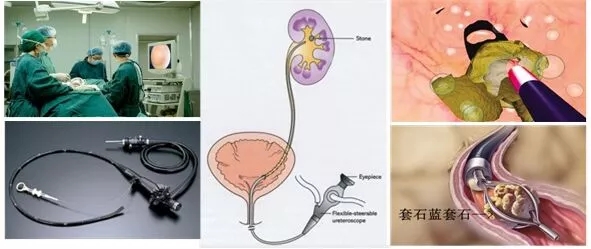 求支招！肾结石疼痛要怎么缓解？(图3)