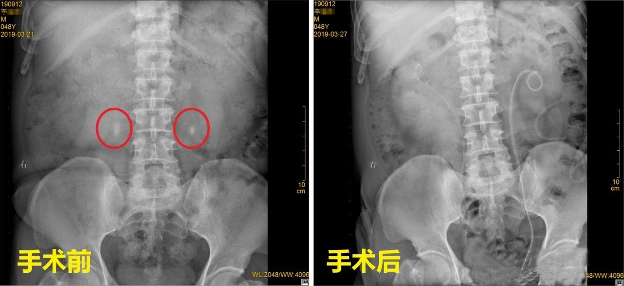 体外碎石？吃药排石？小心4年后，像他一样“排尿通道”全堵(图1)